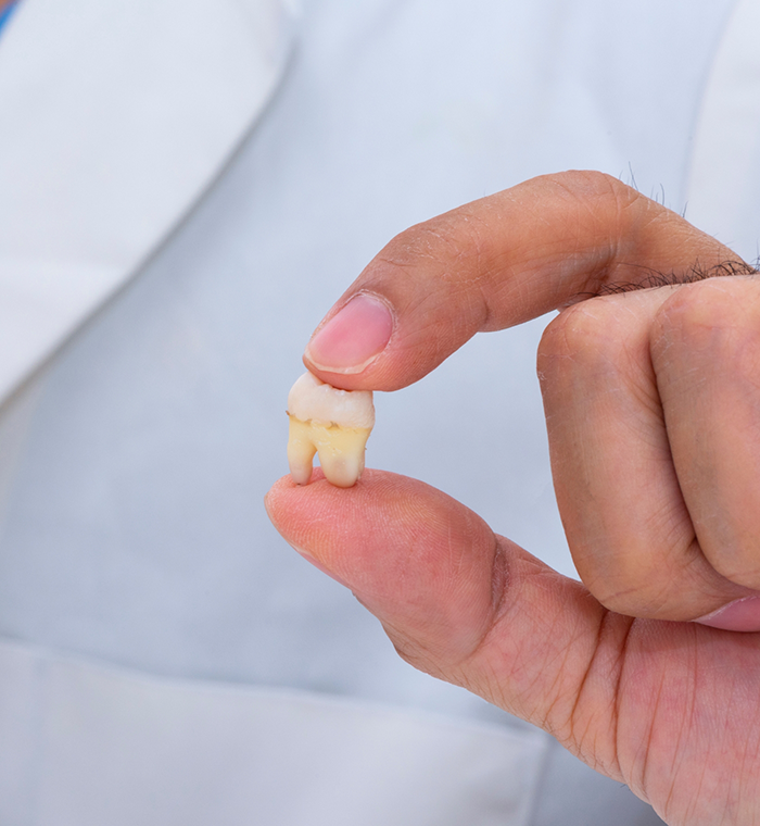 Close up of extracted tooth held between finger and thumb