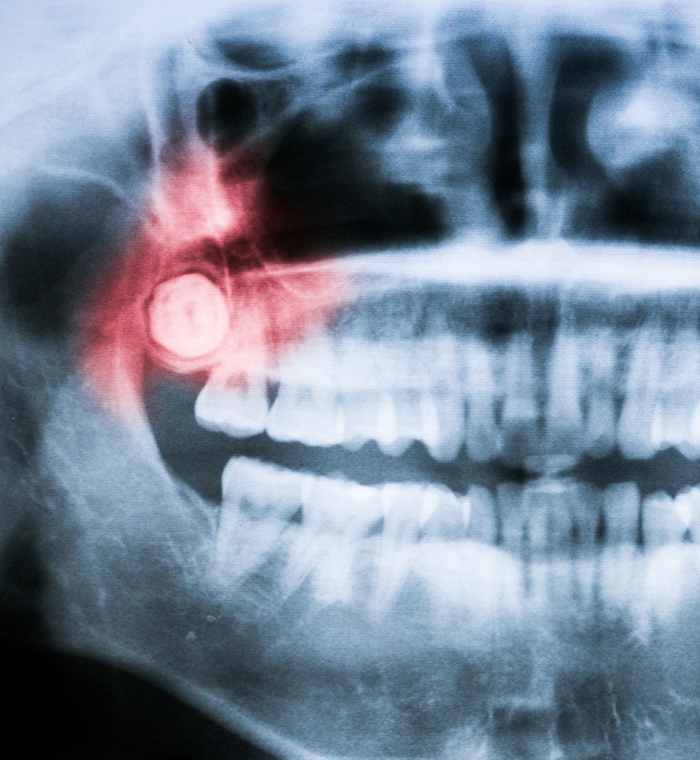 X-ray showing an impacted wisdom tooth