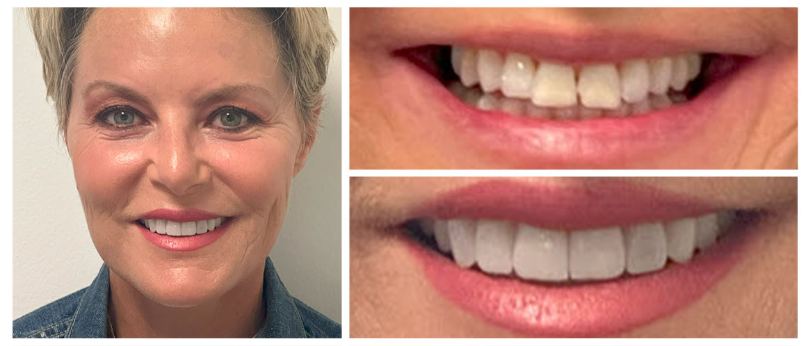 The image shows a person with short hair smiling at the camera, with four photos overlaying the main image showing their teeth being cleaned by a dental hygienist.