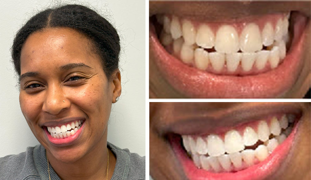 The image shows a woman with a radiant smile, displaying her teeth after receiving dental treatment, which includes braces and possibly teeth whitening, captured from three different angles within a single frame, highlighting her transformation.