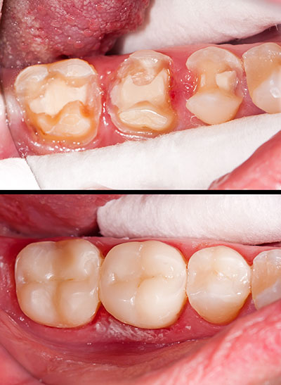 The image shows two photographs side by side  one of an open mouth with teeth showing signs of decay and gum disease, and another of a similar mouth after dental treatment, revealing improved oral health.