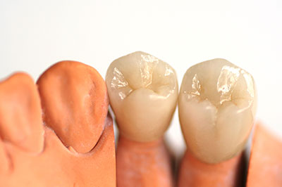 The image shows two rows of artificial teeth with a brownish hue, placed side by side against a white background.