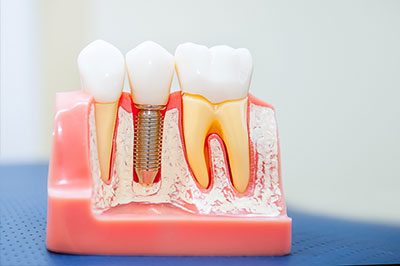 The image shows a dental model with artificial teeth and gums, featuring a visible screw-like implantation device used for dental implants.