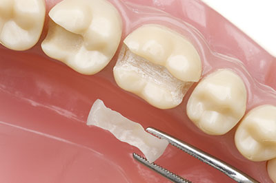 The image shows a dental implant being installed into a prepared tooth socket within an open mouth model.