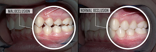 The image shows a side-by-side comparison of a mouth with teeth before and after dental treatment, highlighting the transformation from malocclusion to normal occlusion.