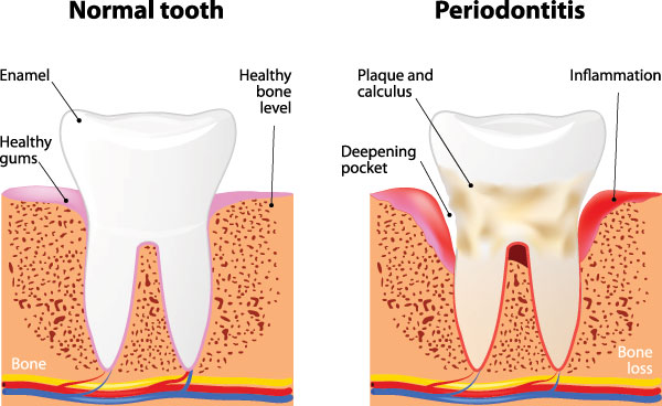 The image shows a detailed 3D illustration of a tooth with normal and periodontitis states, highlighting differences in bone density and gum health around the teeth.