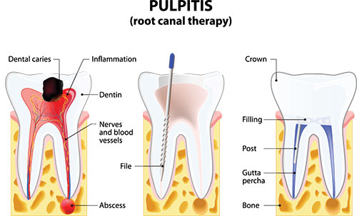 The image displays a step-by-step illustration of a dental procedure labeled  Pulpitis  root canal therapy   with annotations explaining each stage, including the initial pulp inflammation, filling of the pulp chamber, and final crown placement.