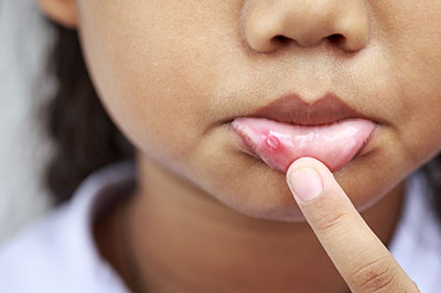 A young child with acne on their face, holding their finger near a pimple.