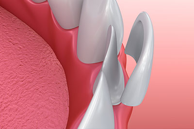 The image shows a close-up view of a dental implant with a pink gum tissue background, highlighting the metallic structure of the implant.