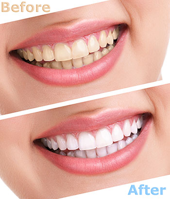 The image shows a before-and-after comparison of teeth whitening, with two sets of teeth displayed side by side, highlighting the difference between untreated and treated teeth, featuring a smile with white teeth against a contrasting background.