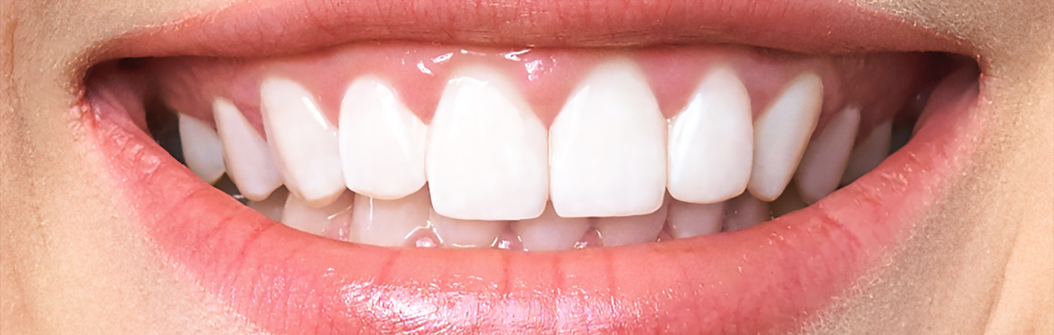Patients Teeth After Teeth Whitening Treatment in Springfield