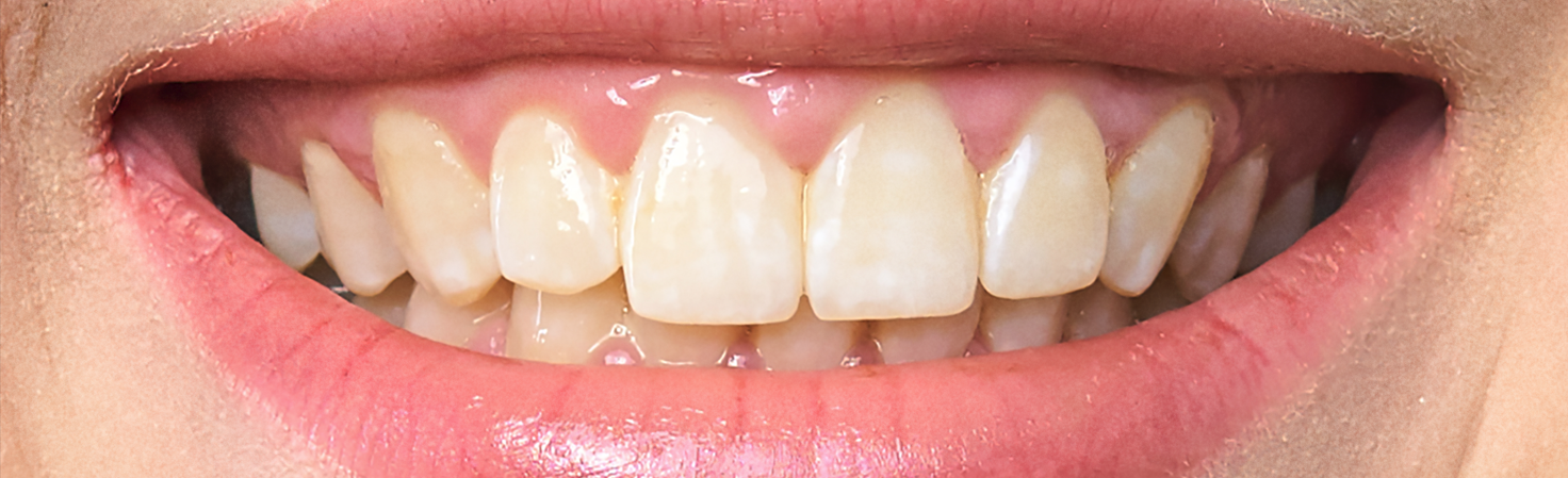 Patients Teeth Before Teeth Whitening Treatment in Springfield