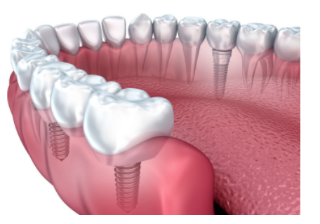 Dental Implants in Springfield & Neptune NJ