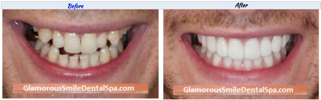 Before and After Dental Treatment Photo in Neptune
