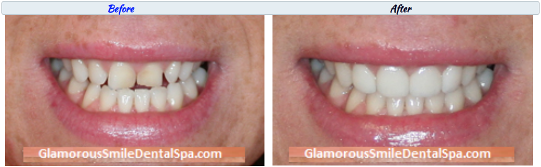 Before and After Dental Treatment Photo in Short Hills