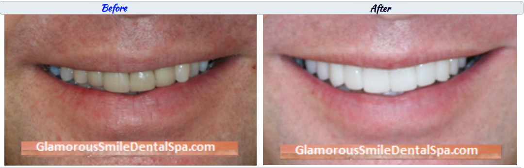 Before and After Dental Treatment Photo in Springfield