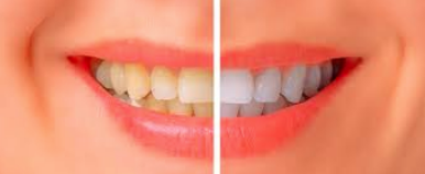 Teeth Whitening Before & After Photo