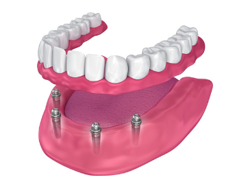 All-On-4 Dental Implants Springfield NJ