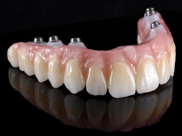 Full-Arch Dental Implants NJ